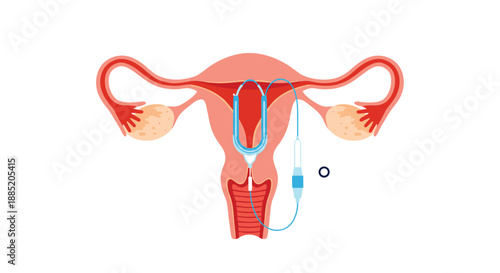 Medical illustration showing the process of an intrauterine device or IUD being inserted into the uterus for birth control.