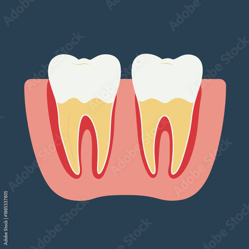 Cross section of two molar teeth with inflamed gums indicating mild periodontitis flat vector illustration on dark background dental health concept