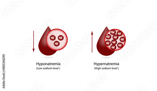 Hypernatremia, high plasma sodium level and Hyponatremia, low plasma sodium level. Sodium Na excess and deficit electrolyte disorders, blood test tube, Scientific design. Vector illustration.