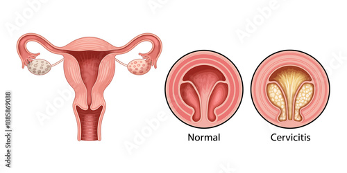 Illustration of female reproductive system with normal and cervicitis