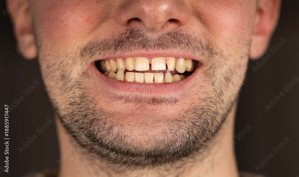 Obraz premium Un avant blanchiment dentaire avec les dents jaunes. 