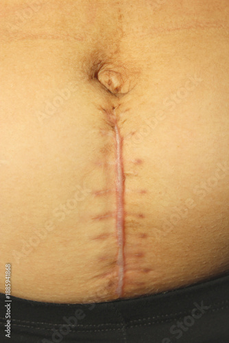 seams after the operation of Caesarian section. Scar from a c-section birth