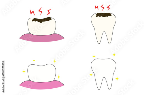 虫歯ときれいな歯