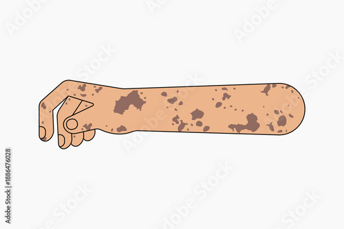 Vitiligo hand arm, gesture flat collage element vector