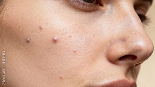 Closeup of Skin Problem with Whiteheads and Acne Pimples