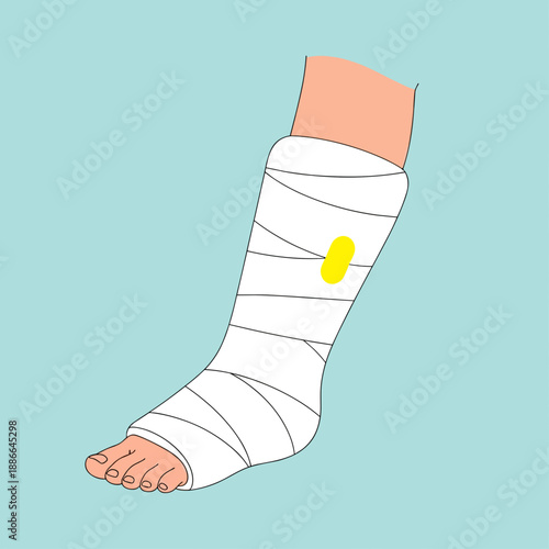 Leg in cast on foot with bandages showing a yellow spot  