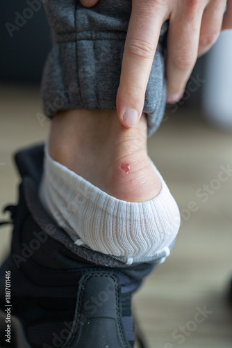 Obraz na płótnie Foot with a painful blister and callus caused by uncomfortable shoes