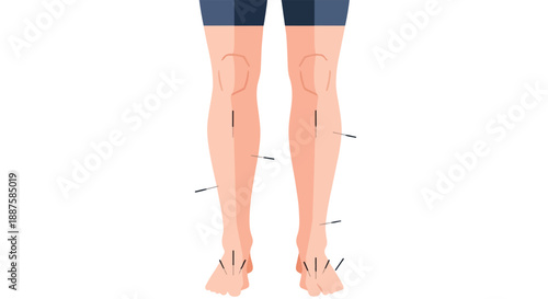 Acupuncture needles in human legs on a white background