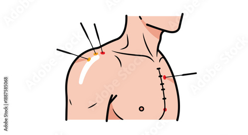 Vector illustration of male torso with acupuncture needles and surgical stitches