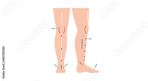 Acupuncture needles in human legs for pain relief and traditional Chinese medicine treatment