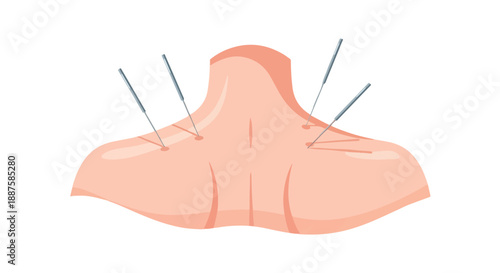 Acupuncture needles in a human neck and shoulders, vector illustration