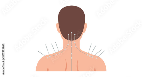 Acupuncture needles in a person's back and neck, vector illustration