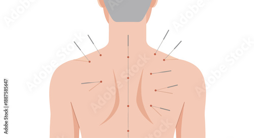 Acupuncture needles in a person's back, traditional Chinese medicine treatment