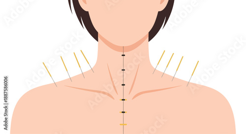 Acupuncture needles in a person's neck and shoulders with meridian points