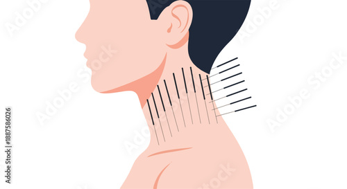 Acupuncture needles in a person's neck and shoulder for pain relief