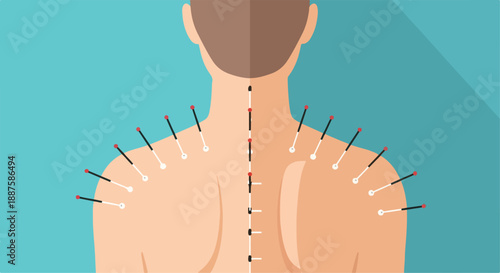Acupuncture needles in a human back with long shadow on blue background