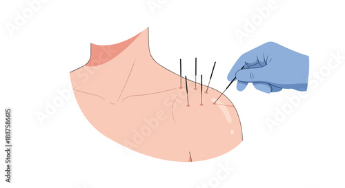 Acupuncture needles in shoulder with gloved hand applying treatment