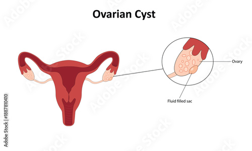 Ovarian cyst vector illustration