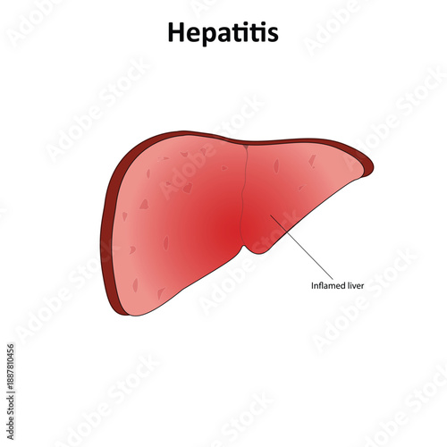 Hepatitis vector illustration