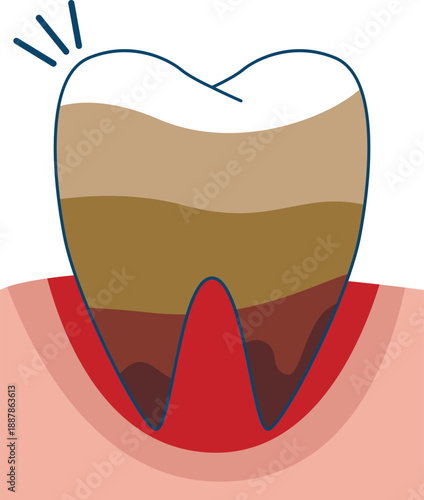A vector illustration of a decayed tooth, demonstrating the importance of dental treatment, oral hygiene, and preventative care. Includes medical-style graphics depicting a decayed tooth, ideal for ed