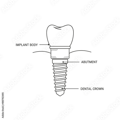 Dental implant diagram showing implant body, abutment, and crown  