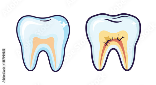 Illustration comparing a healthy tooth to one with significant decay