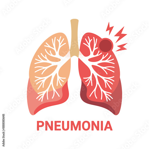 Illustration depicting human lungs affected by pneumonia with inflammation shown
