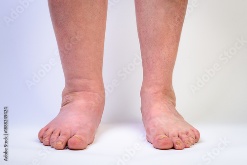Tableau sur toile Swelling of the leg after a fall injury on gray background.