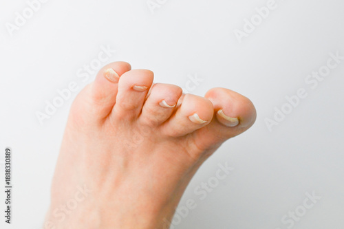 巻き爪・陥入爪の症状が出ている足の爪
