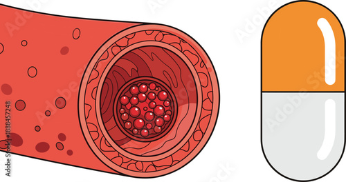 Blood vessel artery cross section illustration with cholesterol plaque and medicine capsule showing cardiovascular disease, atherosclerosis treatment, medical healthcare concept for cardiology