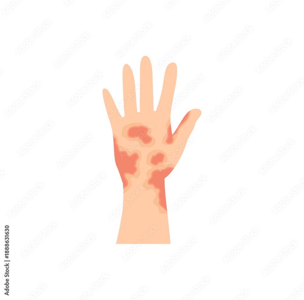Fototapeta premium Dermatitis eczema skin conditions and disease. Vector illustration