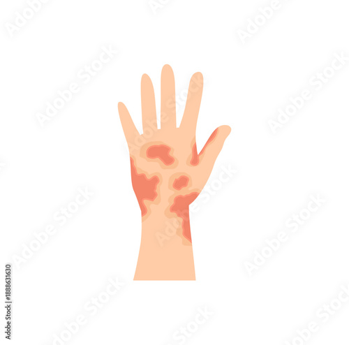 Dermatitis eczema skin conditions and disease. Vector illustration