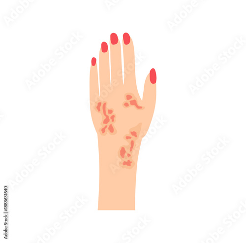 Dermatitis eczema skin conditions and disease. Vector illustration