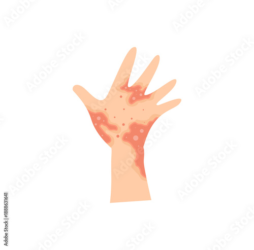 Dermatitis eczema skin conditions and disease. Vector illustration
