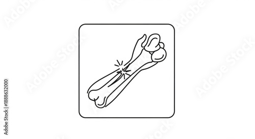 A fractured bone is depicted in a simple line drawing, showcasing the breakage and damage from a medical illustration viewpoint.