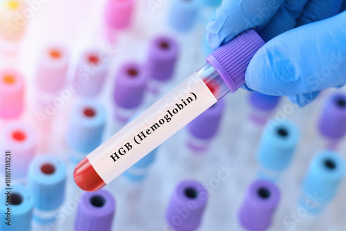 A doctor holding a blood sample tube for a hemoglobin (HGB) test. Laboratory diagnostics of red blood cells and oxygen transport, detection of anemia, general blood assessment, space for text