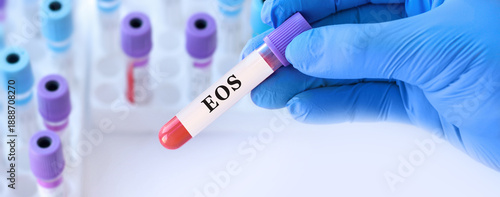 Cuadro en lienzo Doctor holding blood sample tube for eos test, laboratory diagnostics of eosinop