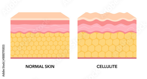 Cellulite and normal skin structure vector illustration.