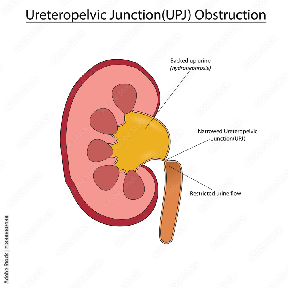 Ταπετσαρία Ureteropelvic Junction (UPJ) obstruction vector illustration