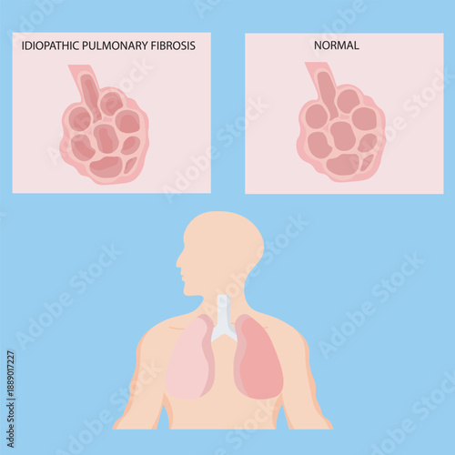 Vector illustration of idiopathic pulmonary fibrosis showing breathlessness, dry cough, fatigue, and lung scarring, with related conditions such as interstitial lung disease and pneumonitis silhouette