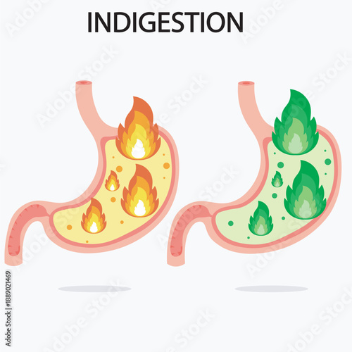 Vector illustration of indigestion showing bloating, nausea, heartburn, abdominal discomfort, with related conditions such as gastritis, acid reflux, and peptic ulcer disease pain