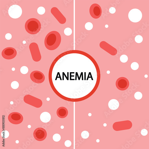 comparison of normal blood versus iron-deficiency anaemia showing fewer red cells, linked with fatigue, pallor and dizziness, and similar to thalassemia or vitamin B12 deficiency.
