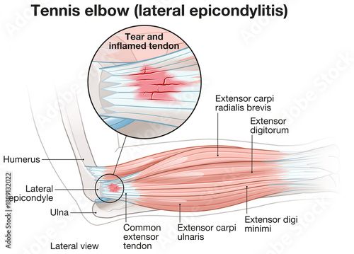Tennis elbow injury with inflamed extensor tendon anatomy illustration