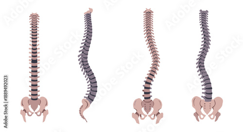 Four human spine models showing different curvatures and conditions on white background