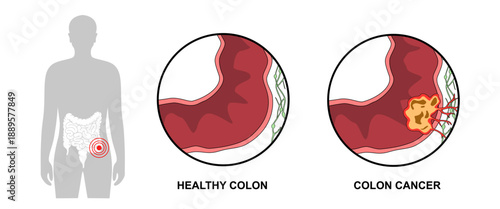 Colorectal cancer, Comparison of healthy colon with colon cancer. Concept of colon cancer. Medical vector illustration for clinics, education, and science.