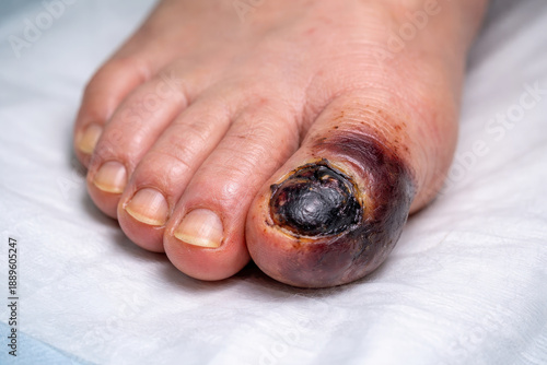 Severe diabetic foot ulcer glucose blood sugar crisis requiring urgent insulin care warning
