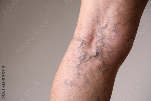 Wallpaper Mural Elderly leg varicose vein spider vein blood vessel skin closeup medical health vascular disease human body healthcare diabetic care Glucose and insulin affect blood sugar and can impact varicose Torontodigital.ca