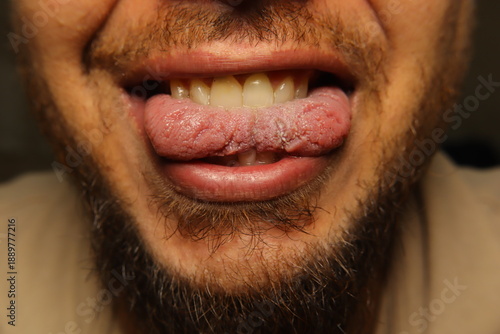 Closeup Cracked human tongue showing dryness and fissures, often linked to dehydration or vitamin deficiency. Useful for medical education, healthcare awareness, oral health content and diagnostics,