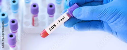 Doctor holding blood sample tube for eos test, laboratory diagnostics of eosinophil levels for allergy detection, parasitic infection screening and immune response evaluation in clinical medicine,