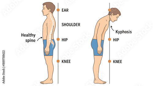 An illustration comparing a healthy spine with kyphosis in two side views